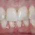 Dental Case of the Week: One Front Tooth
