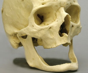 bone skull dentures teeth edentulous implants changes denture any