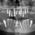 Implants from Mexico