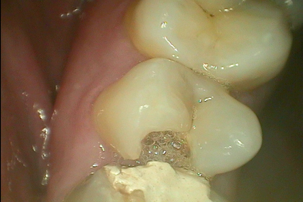 why my tooth hurts after getting it filled
