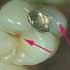 Tooth Decay: what does a cavity look like?