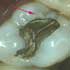 Silver Fillings: Why replace them?
