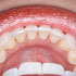 Six Weeks of Hidden Braces