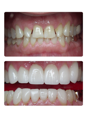 before-after-crowns-12
