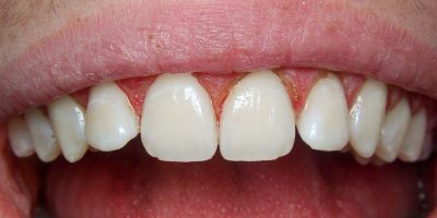 RECONTOUR Gum Tissue - [AFTER]